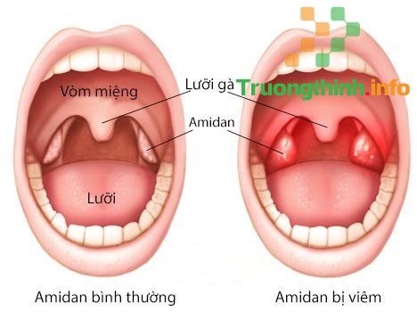 Dấu hiệu viêm amidan là gì? Viêm amidan có tự khỏi không?