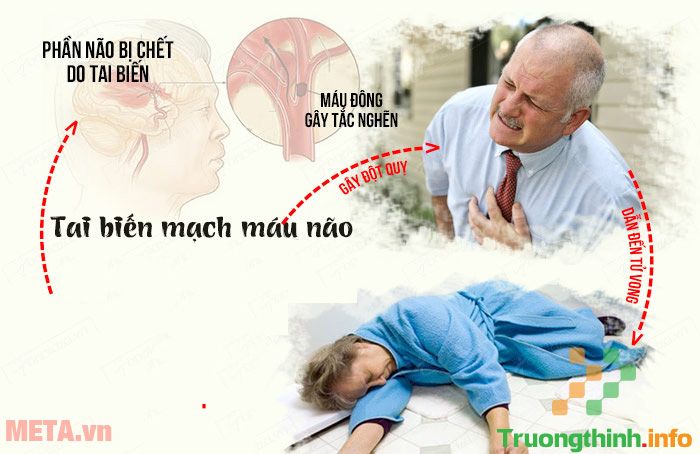                       Những biện pháp hữu hiệu phục hồi di chứng sau tai biến mạch máu não