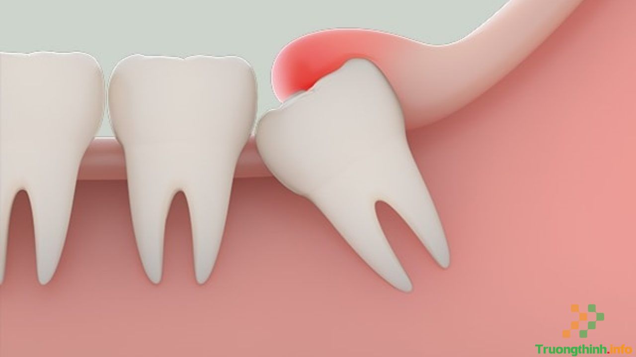                       Răng khôn là gì? Răng khôn là răng số mấy?