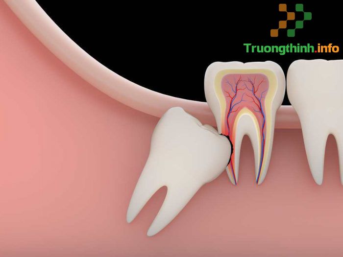                       Răng số 8 là răng gì, có nên nhổ không? Nhổ răng số 8 có đau không?