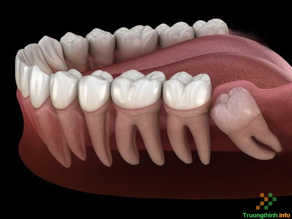                       Răng số 8 là răng gì, có nên nhổ không? Nhổ răng số 8 có đau không?