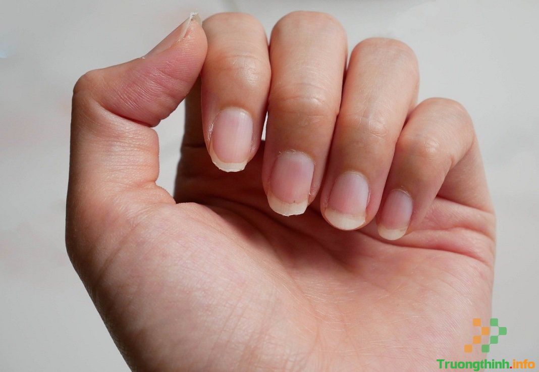                       Móng tay, móng chân bị đen, có vệt trắng, bị hư thối, bị sần là thiếu chất gì, bệnh gì?