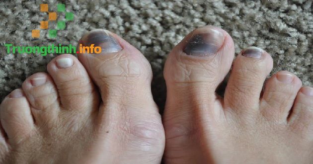                       Móng tay, móng chân bị đen, có vệt trắng, bị hư thối, bị sần là thiếu chất gì, bệnh gì?