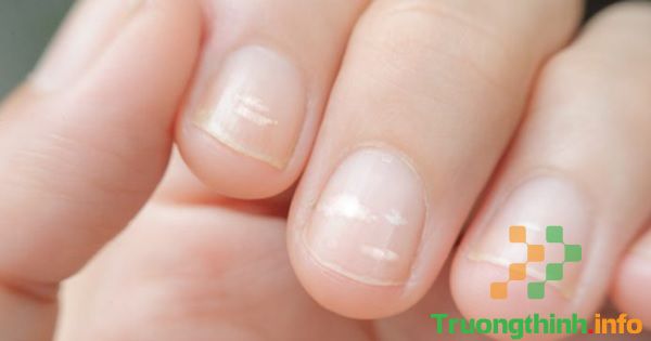                       Móng tay, móng chân bị đen, có vệt trắng, bị hư thối, bị sần là thiếu chất gì, bệnh gì?