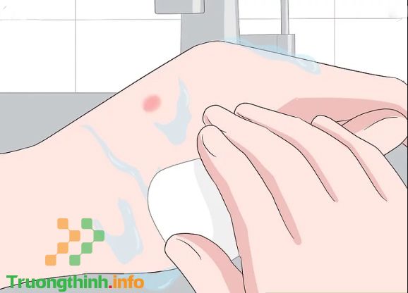                       Ong đốt bôi gì? Cách xử lý khi bị ong đốt tại nhà giúp hết sưng, nhanh khỏi