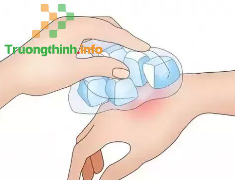                       Ong đốt bôi gì? Cách xử lý khi bị ong đốt tại nhà giúp hết sưng, nhanh khỏi