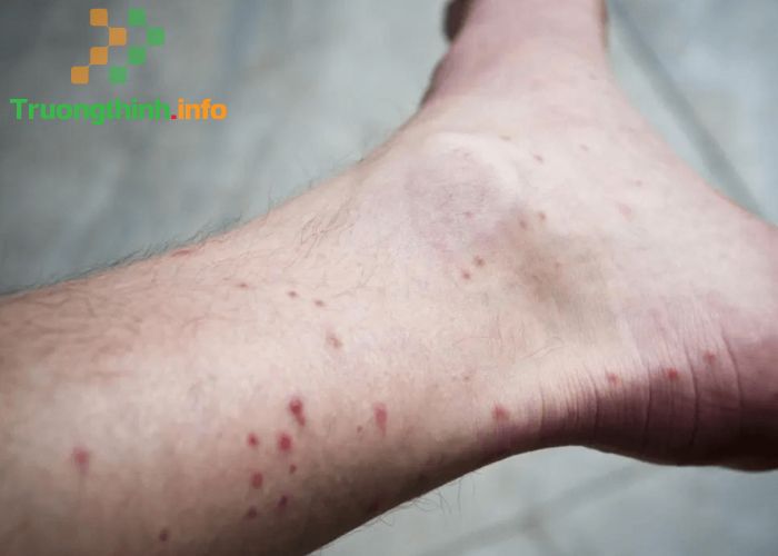                           Những dấu hiệu của bệnh sốt xuất huyết dễ nhận biết