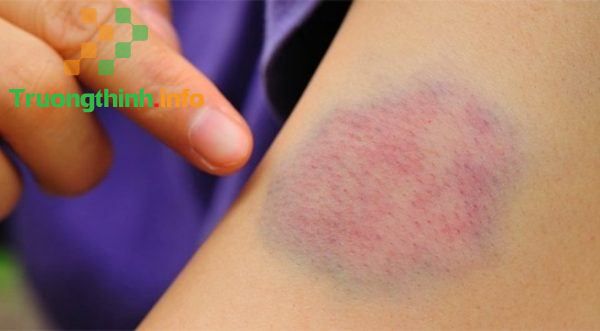                           Những dấu hiệu của bệnh sốt xuất huyết dễ nhận biết